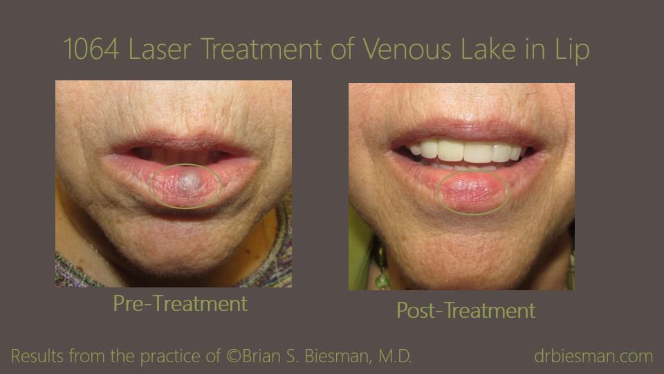 1409MMBSBW 1064 Treatment of Venous Lake