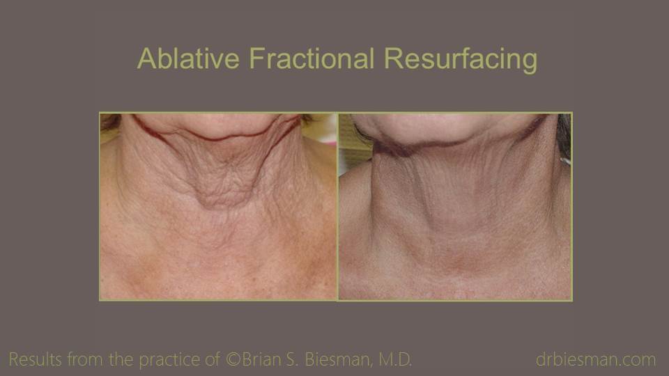 Ablative Fractional Resurfacing Neck_Chest 16_9