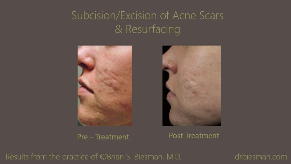 0711FB13BSBW Subcision Excision Resurfacing Acne Treatment LFT