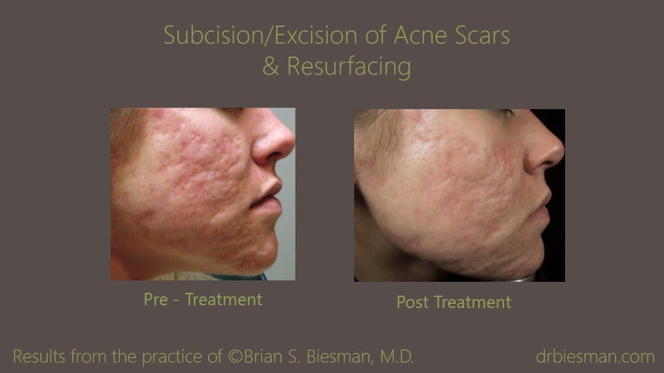 0711FB13BSBW Subcision Excision Resurfacing Acne Treatment RT