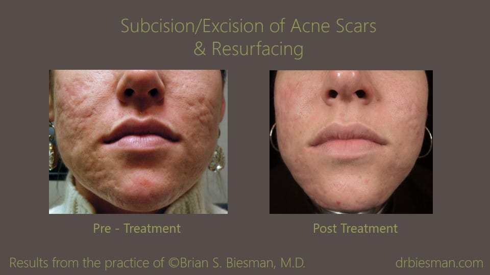 0711FB13BSBW Subcision Excision Resurfacing Acne Treatment