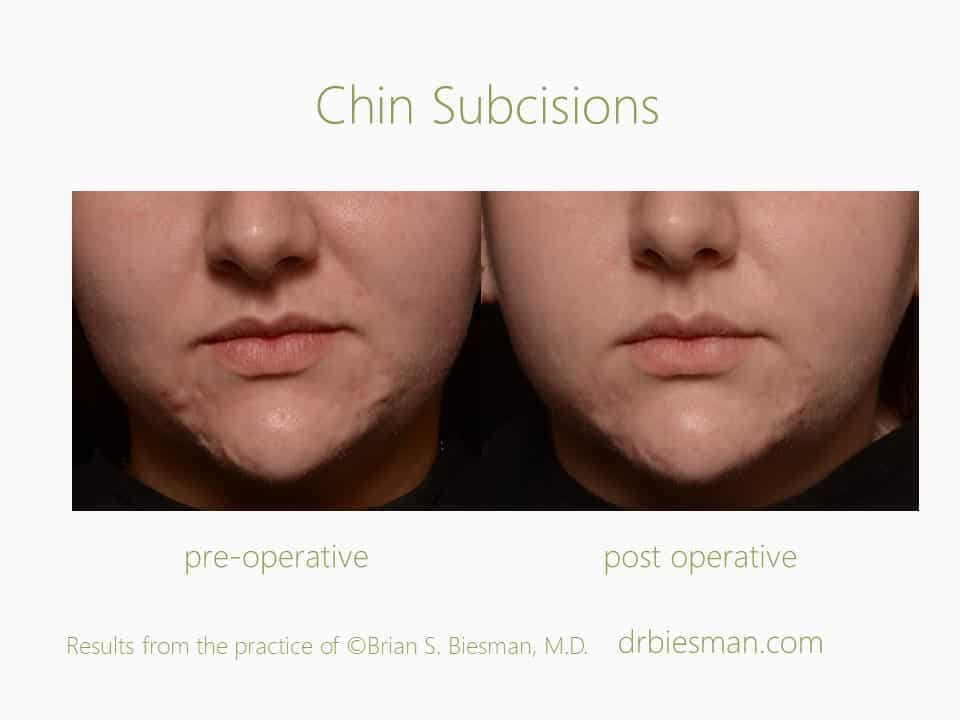 1304YE10-Chin-Subcisions