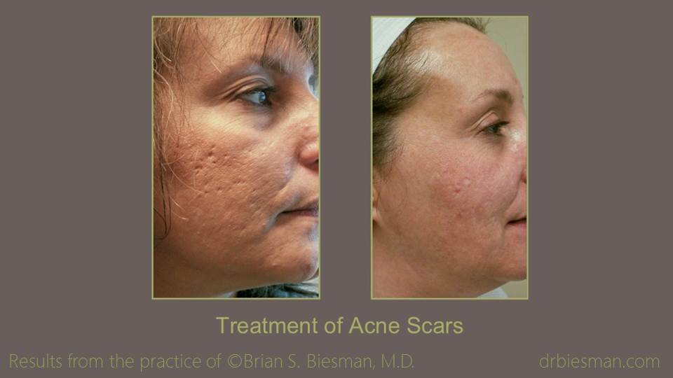 Treatment of Acne Scars 1 16 9