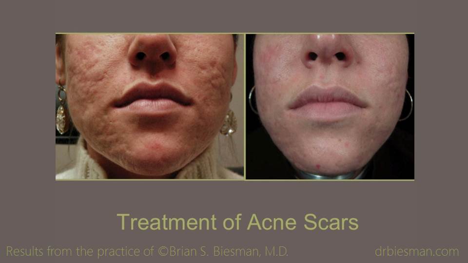 Treatment of Acne Scars 2 16 9
