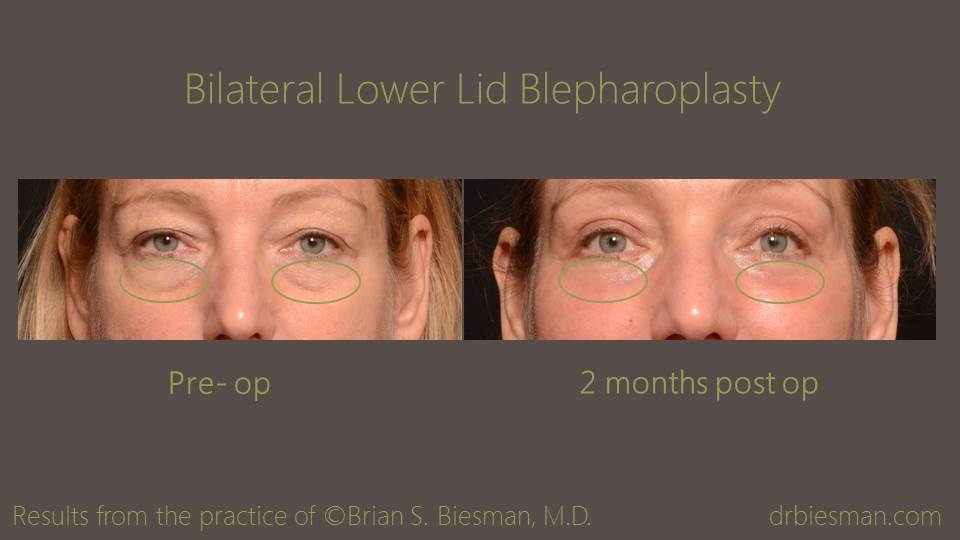 1412BDBSBW Bilateral Lower Lid Blepharoplasty