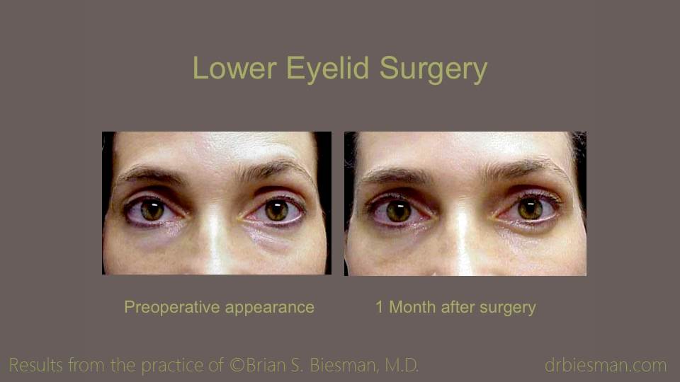 Lower Eyelid Surgery I 16 9