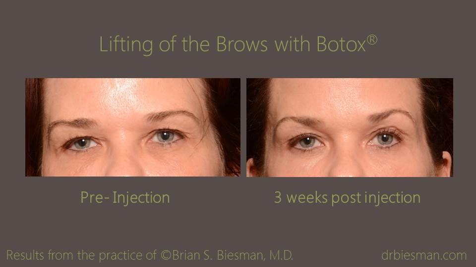 1509PRBSBW Botox Brow lifting