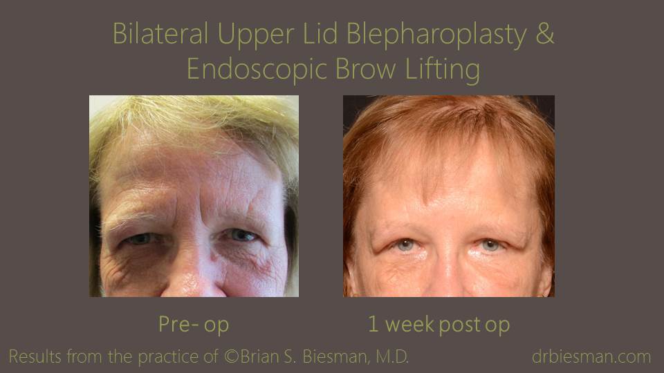 1409MKBSBW Bilateral Upper Lid Blepharoplasty Endobrow