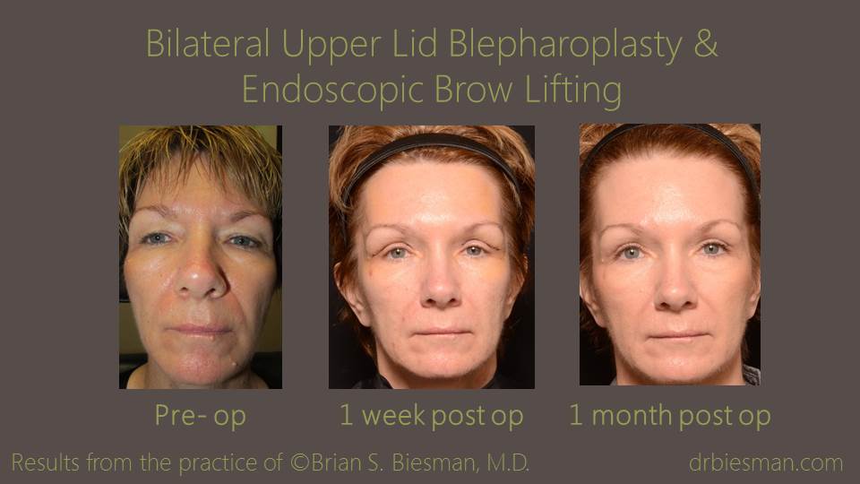 1409RVBSBW Bilateral Upper Lid Blepharoplasty Endobrow
