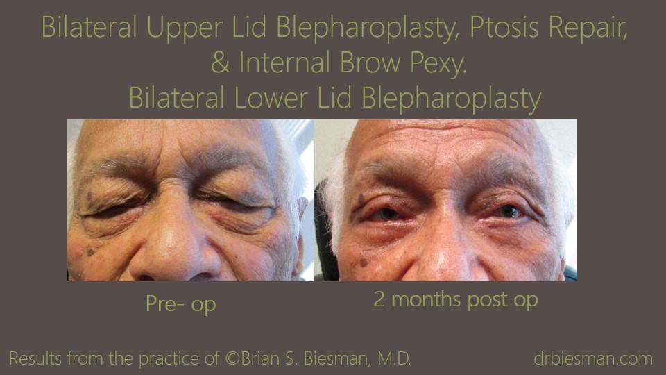1405LRBSBW Bilateral Upper_Lower Lid Blepharoplasty Ptosis repair and pexy