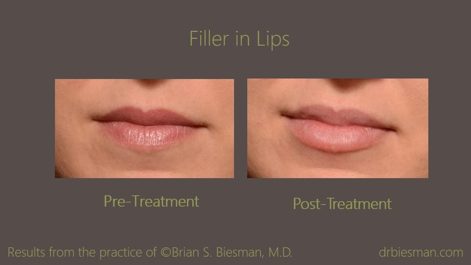 1504CABSBW Filler in lips