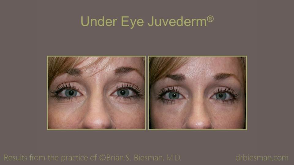 Juvederm Under Eye Treatment 16 9