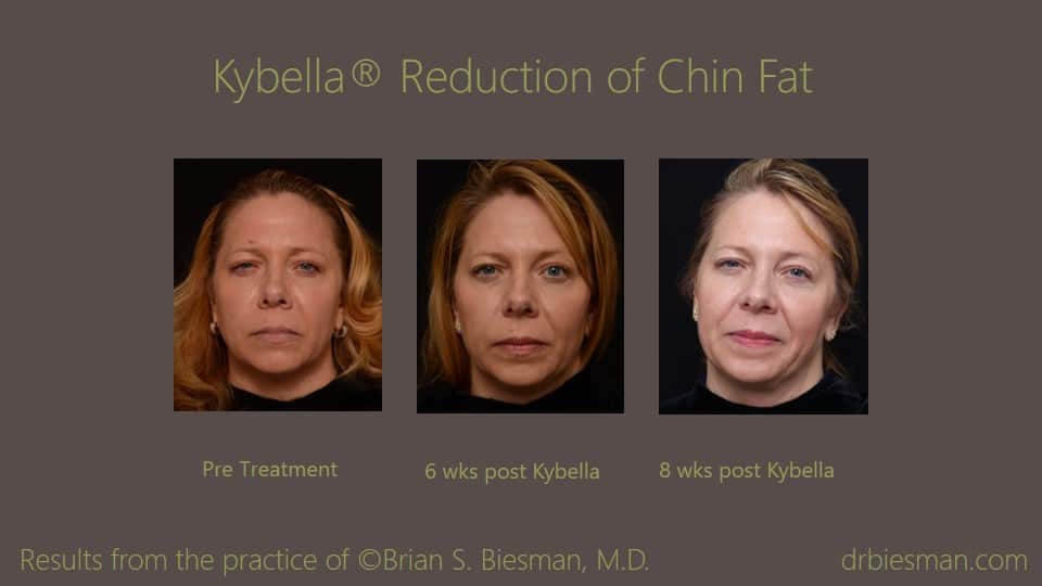 1605MDBSBW Before and After Kybella Front