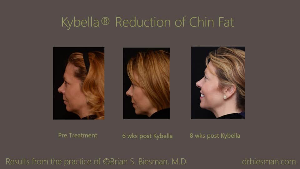 1605MDBSBW Before and After Kybella LFT