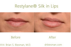 1504CA-Restylane-Silk-in-lips-VD