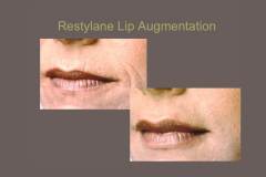 Restylane-in-Lips-16-9