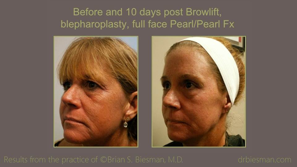 Browlift_Bleph_FF Pearl_Pearl Fractional 16 9