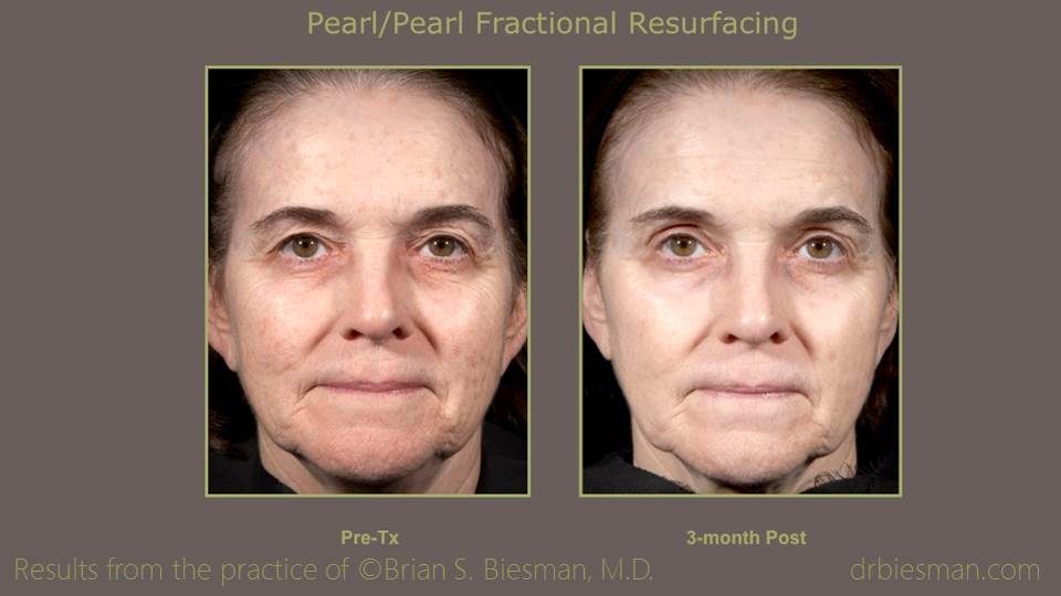 Pearl/Pearl Fractional Resurfacing Before and After Nashville, TN