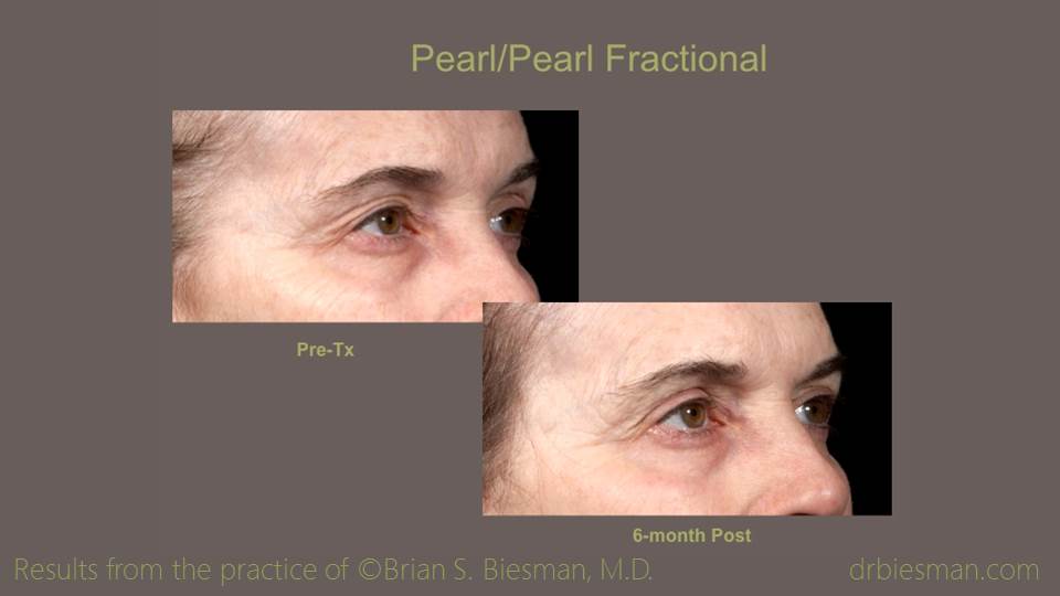 Pearl_Pearl Frational periorbital 16 9