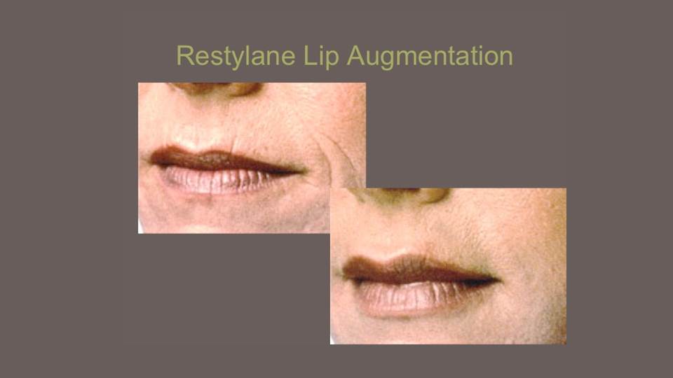 Restylane in Lips 16 9