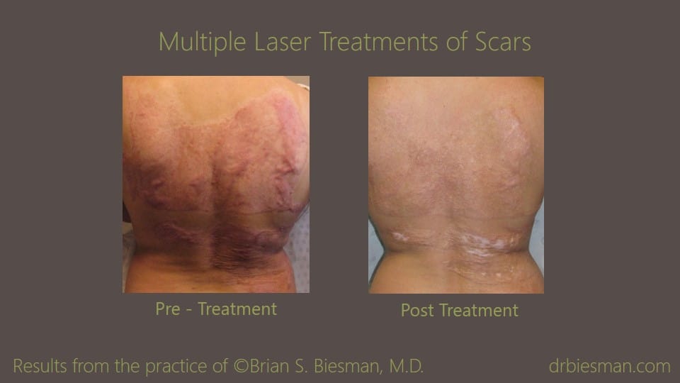 1003MKBSBW Laser Treatment of Scars