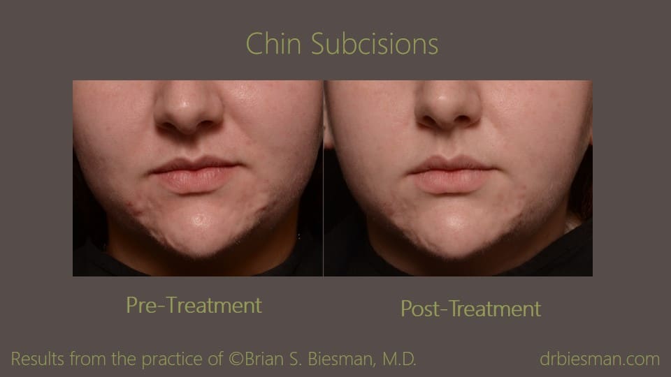 1304YEBSBW Chin Subcisions