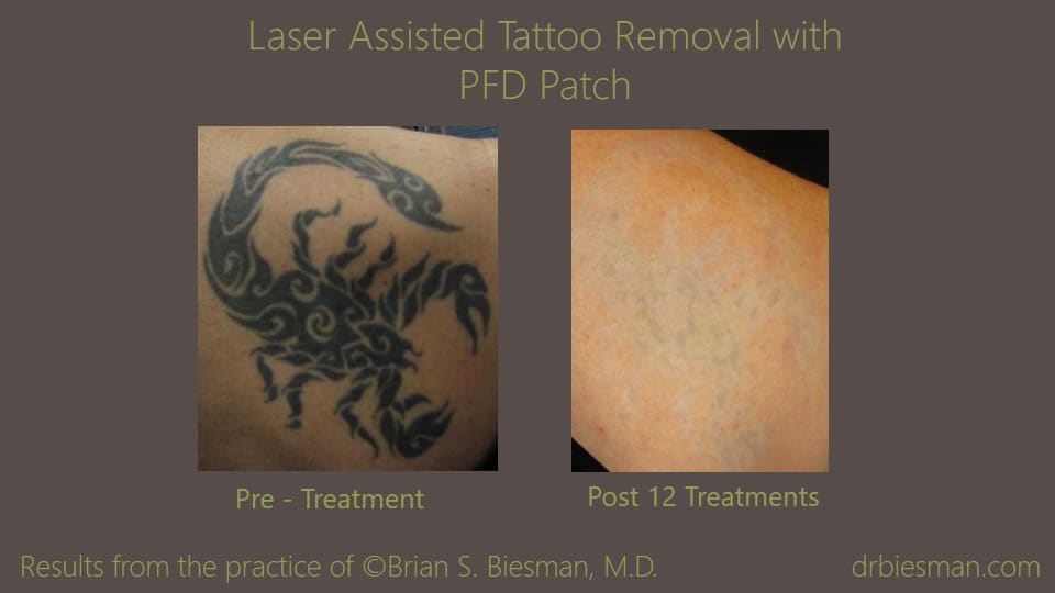1308SMBSBW Laser Assisted Tattoo Removal w PFD Patch