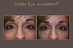 Juvederm-Under-Eye-Treatment