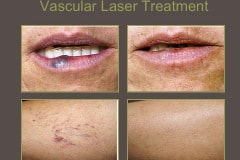Vascular-Laser-TX-Lip