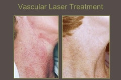 Vascular-Laser-TX-Neck