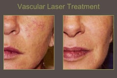 Vascular-Laser-Treatment-Cheak