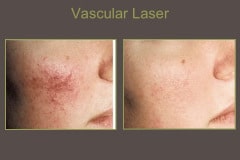 Vascular-Laser-Tx