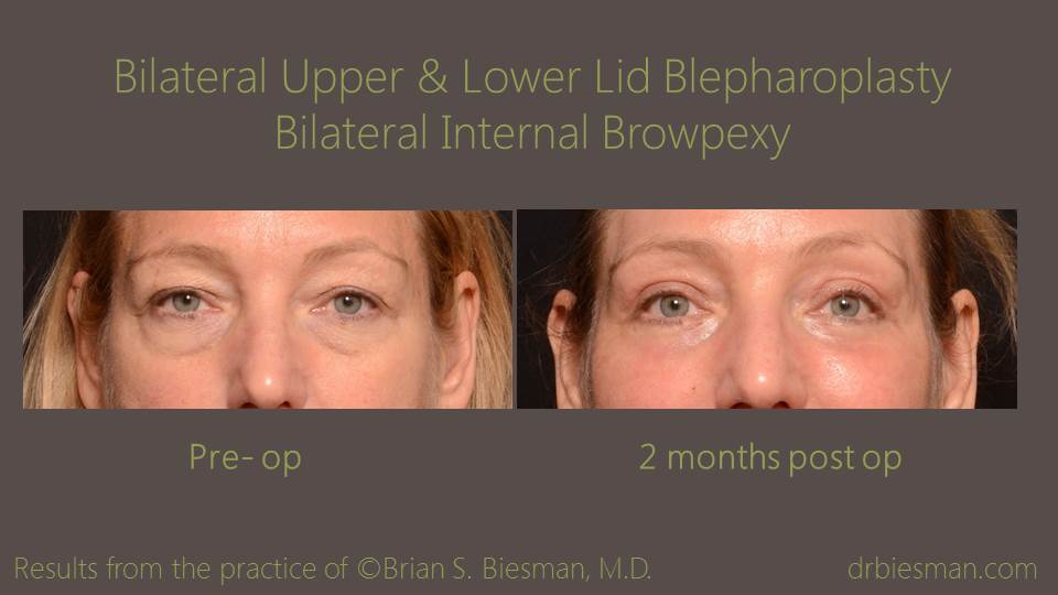 Upper and Lower Lid Belpharoplasty Before and After Photo