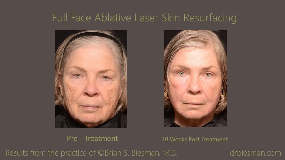 Laser Skin Resurfacing Before and After Photo Nashville, TN