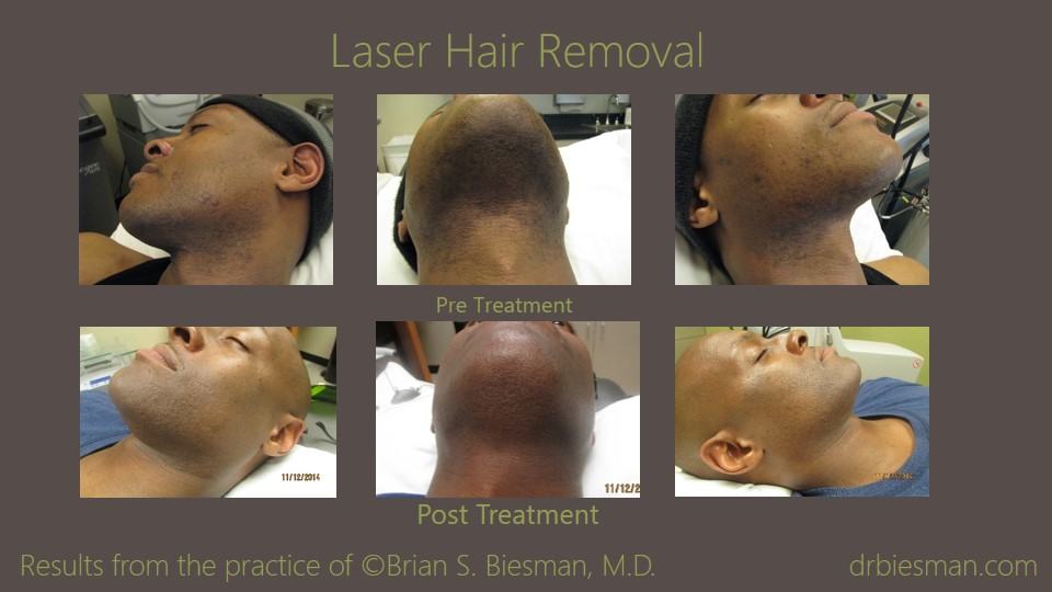 Laser Hair Removal Before and After Photo