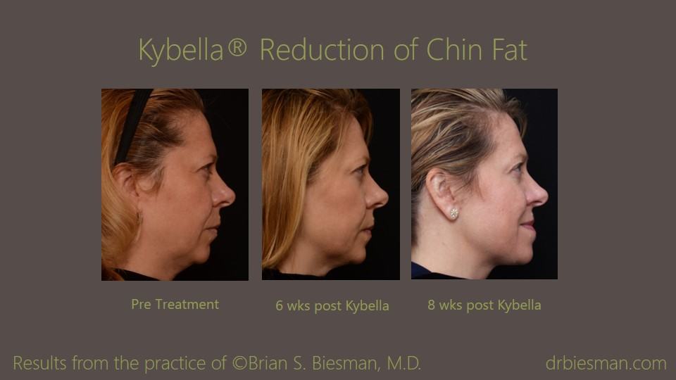 Kybella Double Chin Before and After Photo