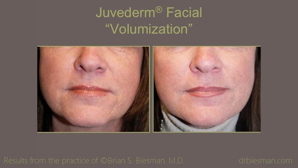 Juvederm Before and After Photo Nashville, TN