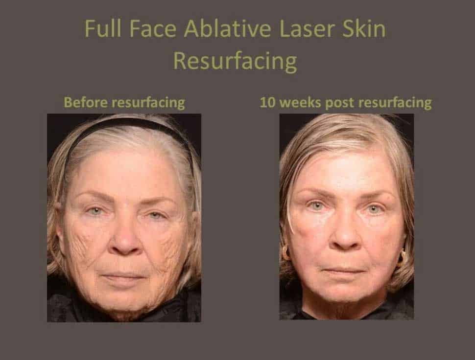 Laser skin resurfacing at Dr. Brian Biesmans in Nashville, TN