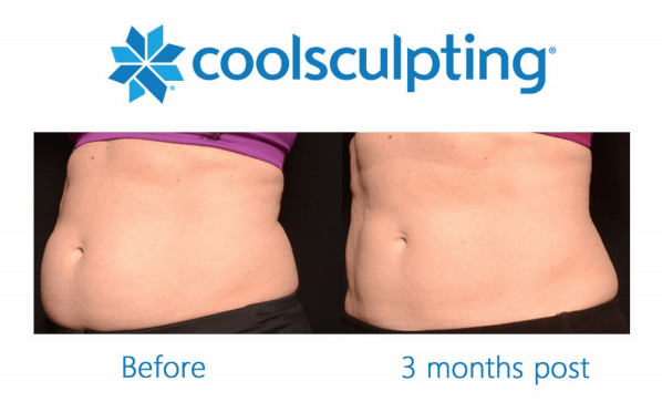 Bathing Suit Ready with CoolSculpting