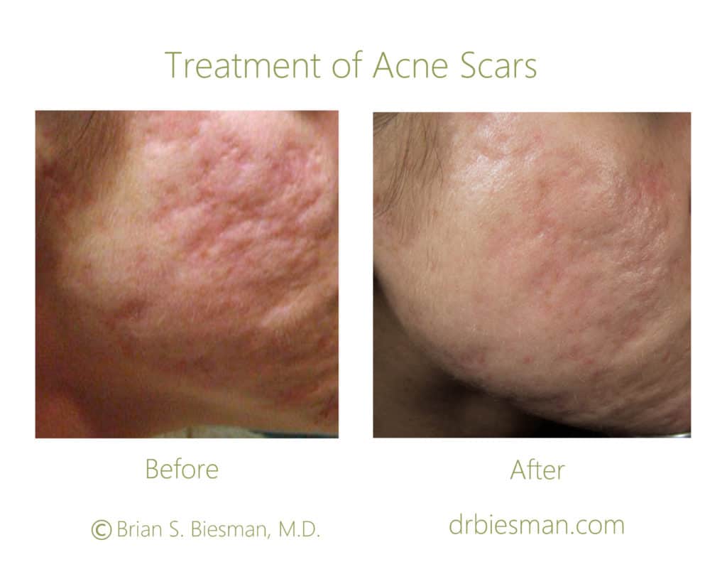 Before and After Acne Scar