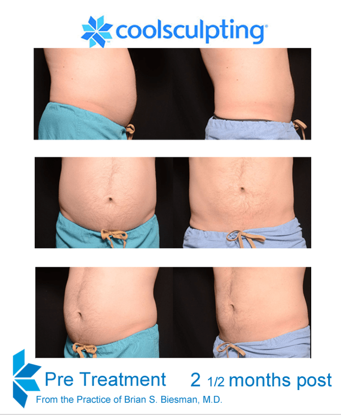 Male CoolSculpting Results