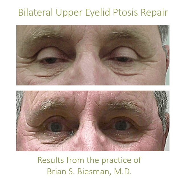 eyelid ptosis repair