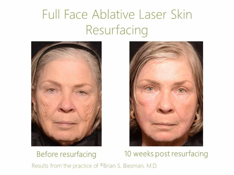 Full Face Laser Skin Resurfacing
