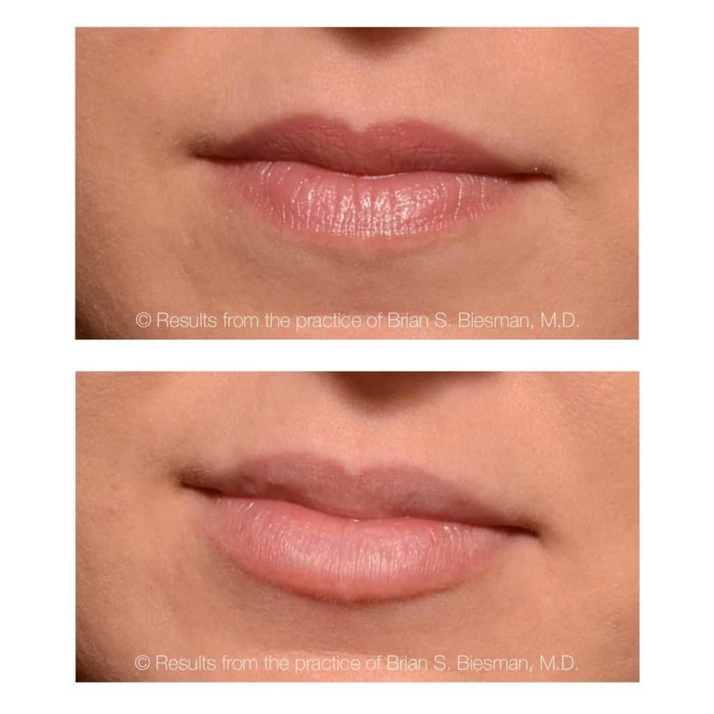 Before and After Lip Filler
