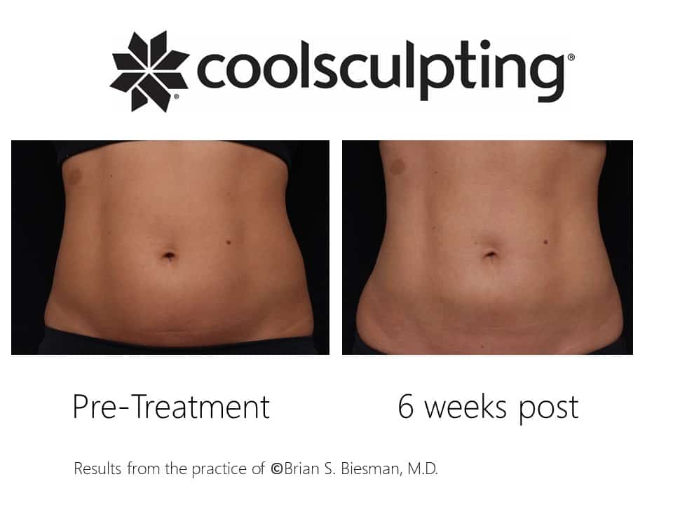 before and After Coolsculpting