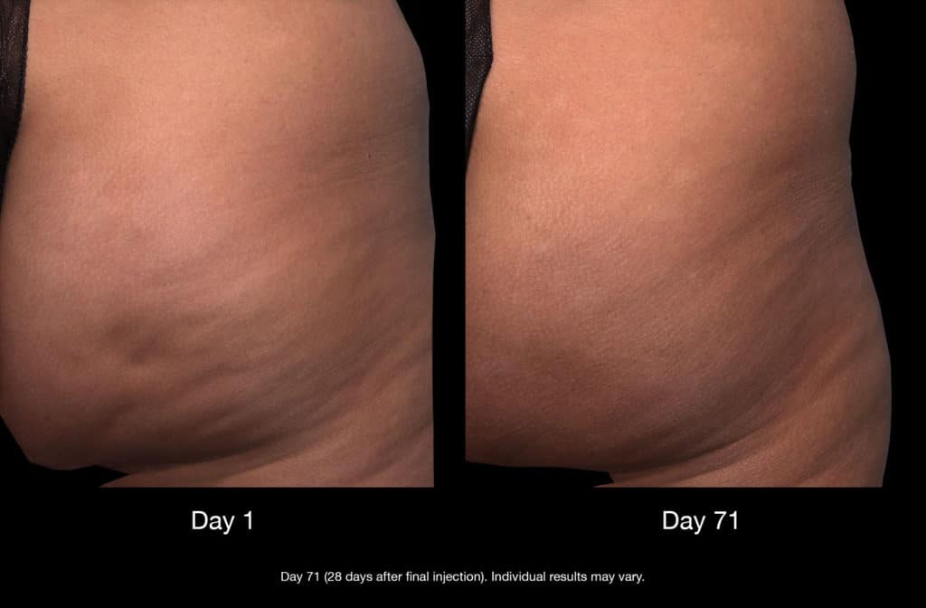 Qwo cellulite treatment before and after