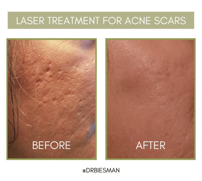 Acne Scarring Treatment Options - Brian S. Biesman M.d.