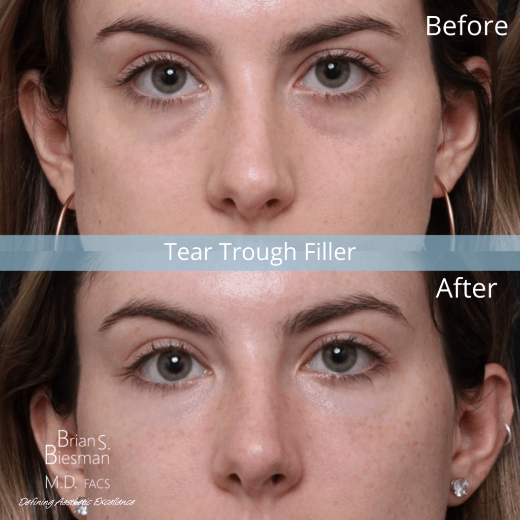 Non-surgical Under Eye Bags Correction with Tear Trough Filler