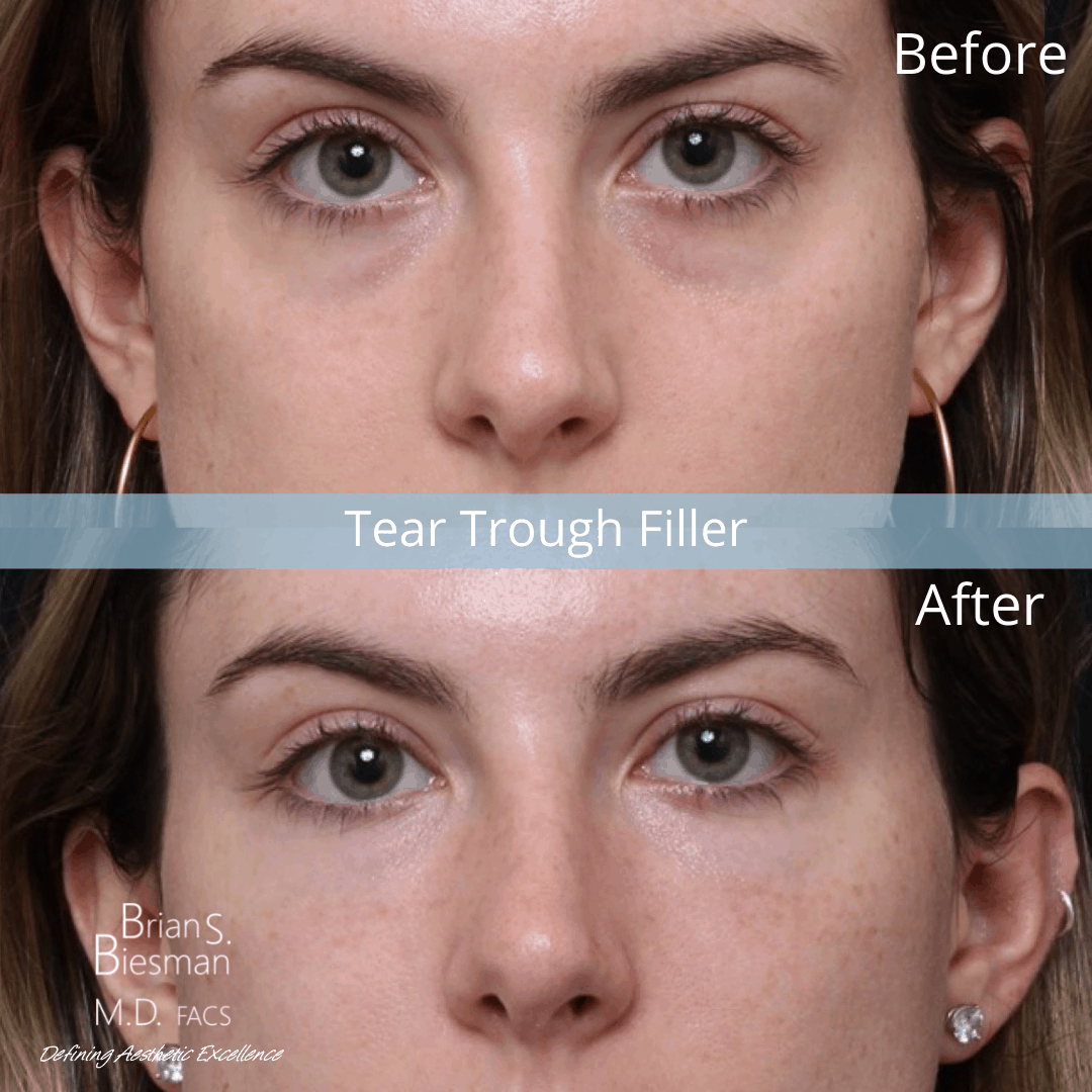 Do You Need Tear Trough Filler or a Blepharoplasty? - Brian S