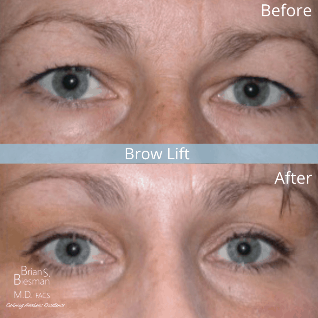 brow lift before and after